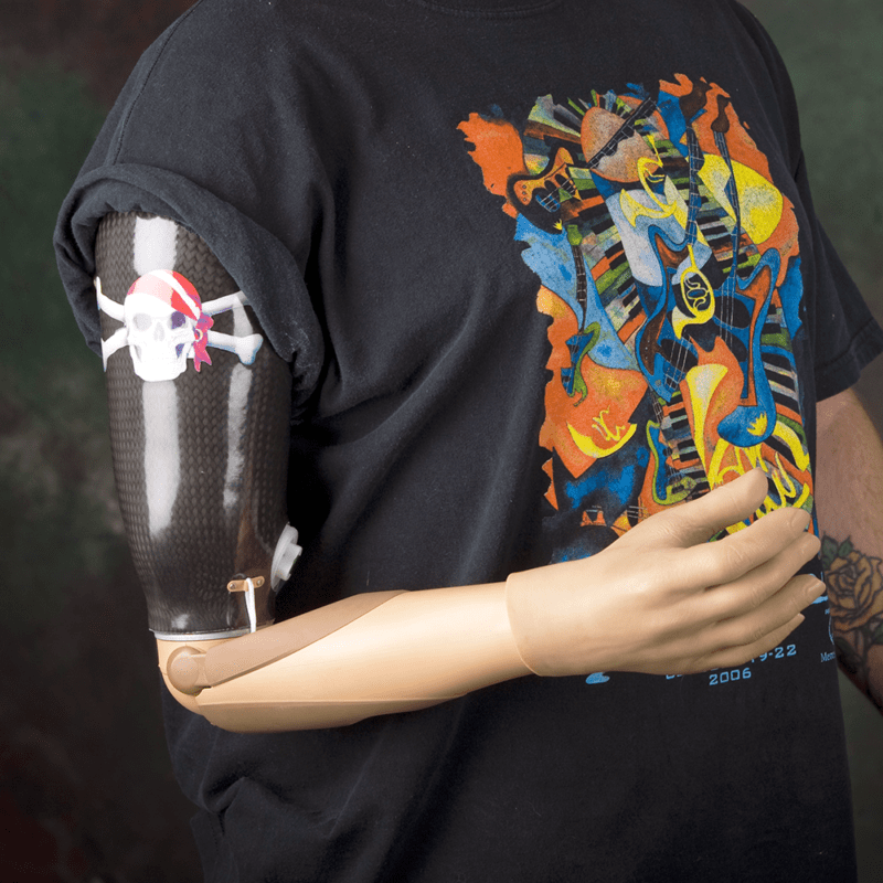 Upper Extremity Prosthetic Devices WestCoast Brace and Limb