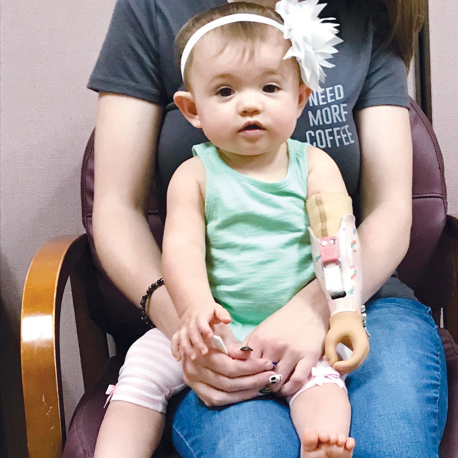 baby girl with a prosthetic arm
