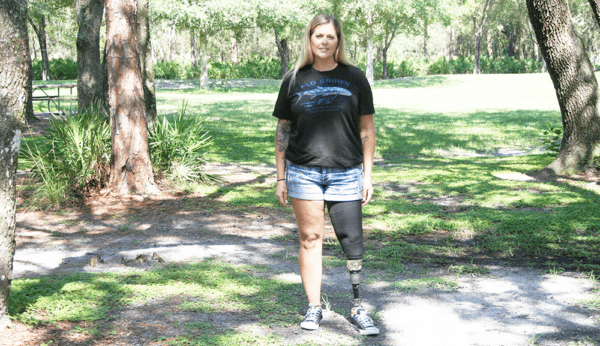 woman patient with a prosthetic leg
