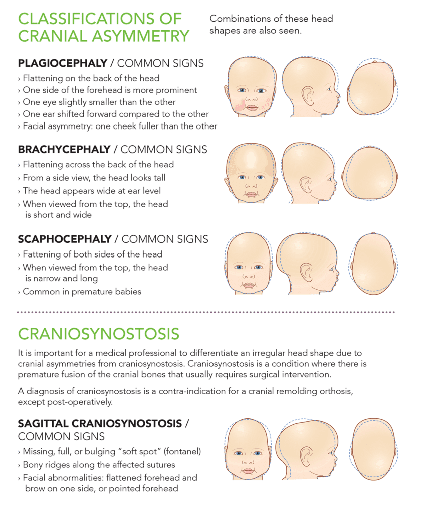 Cranial Remolding Plagiocephaly Treatment Westcoast Brace & Limb