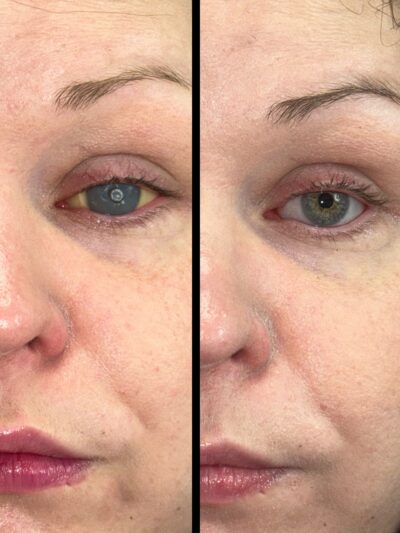 close up of one side of woman's face, showing her eye with and without an ocular prosthetic or artificial eye