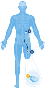 bodyimplantdiagram